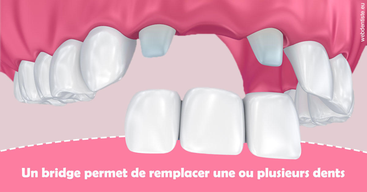 https://www.orthodontie-rosilio.fr/Bridge remplacer dents 2