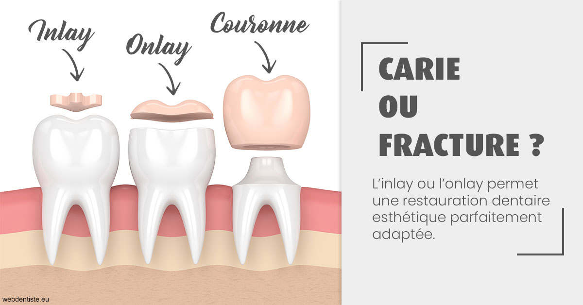 https://www.orthodontie-rosilio.fr/T2 2023 - Carie ou fracture 1