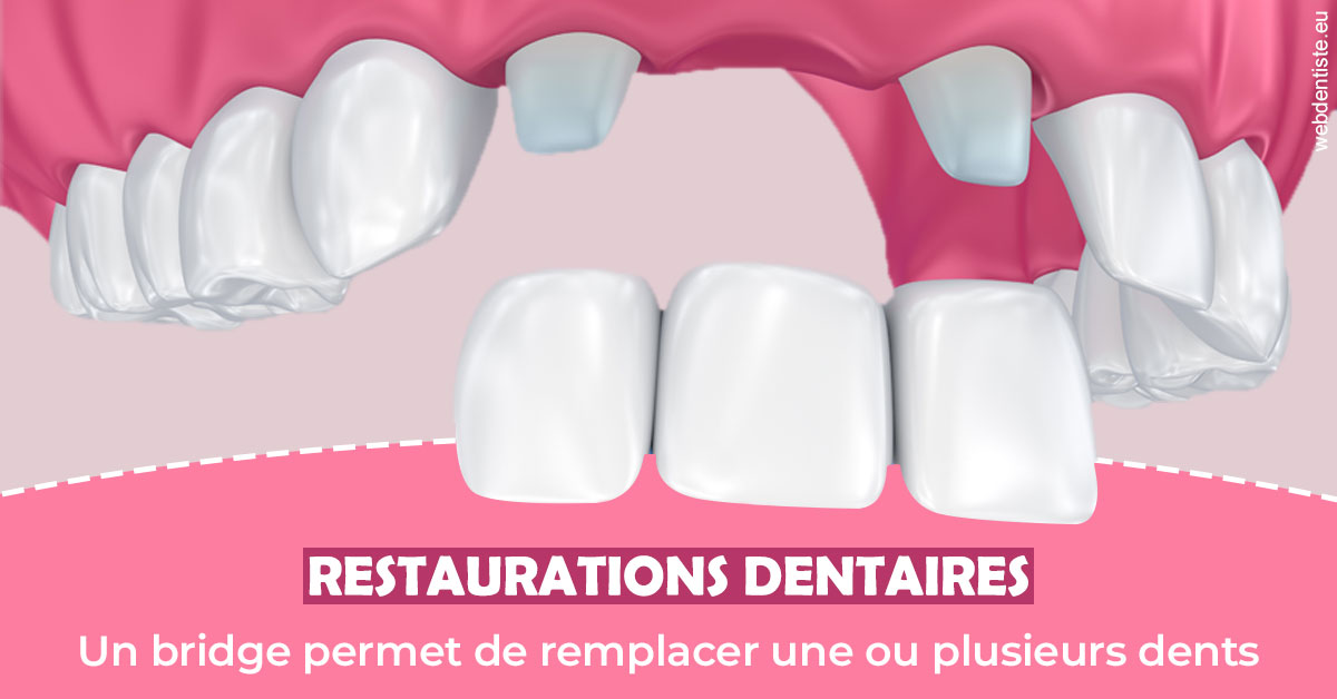 https://www.orthodontie-rosilio.fr/Bridge remplacer dents 2