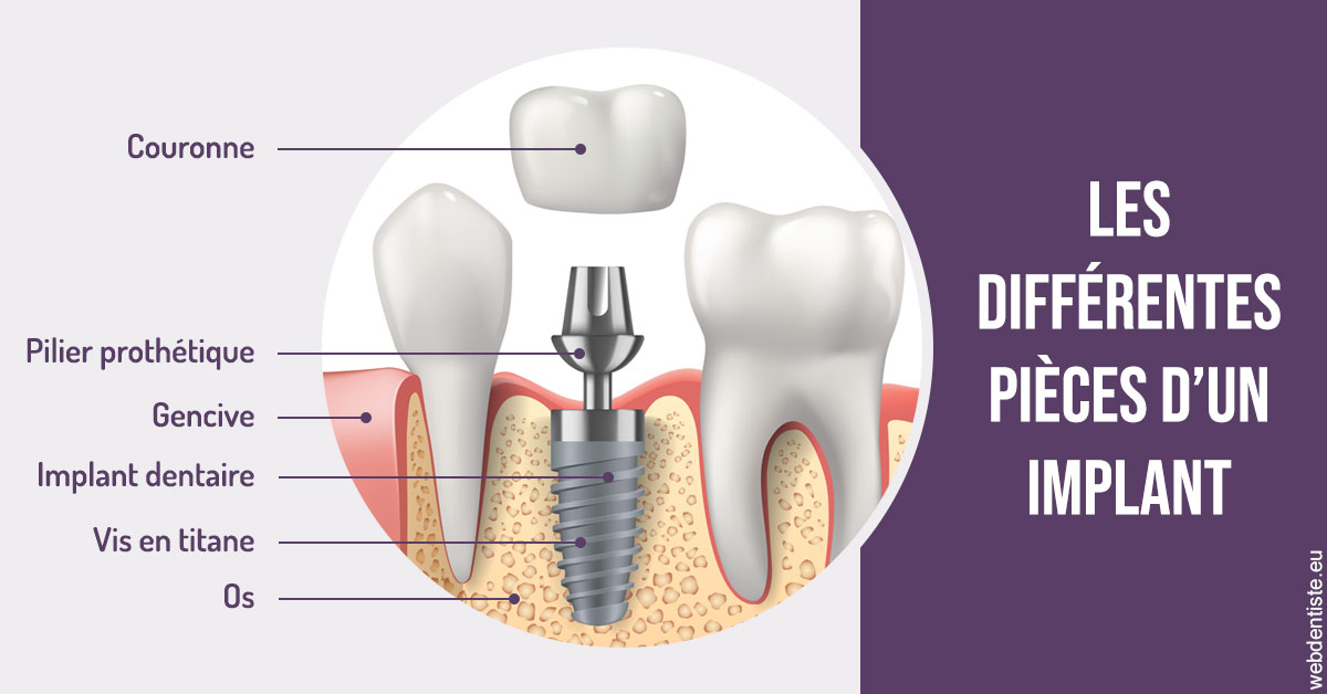 https://www.orthodontie-rosilio.fr/Les différentes pièces d’un implant 2