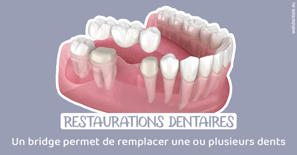 https://www.orthodontie-rosilio.fr/Bridge remplacer dents 1