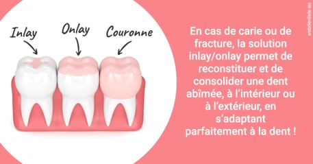 https://www.orthodontie-rosilio.fr/L'INLAY ou l'ONLAY 2