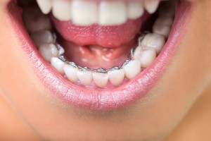 Orthodontie Invisible : l’orthodontie linguale