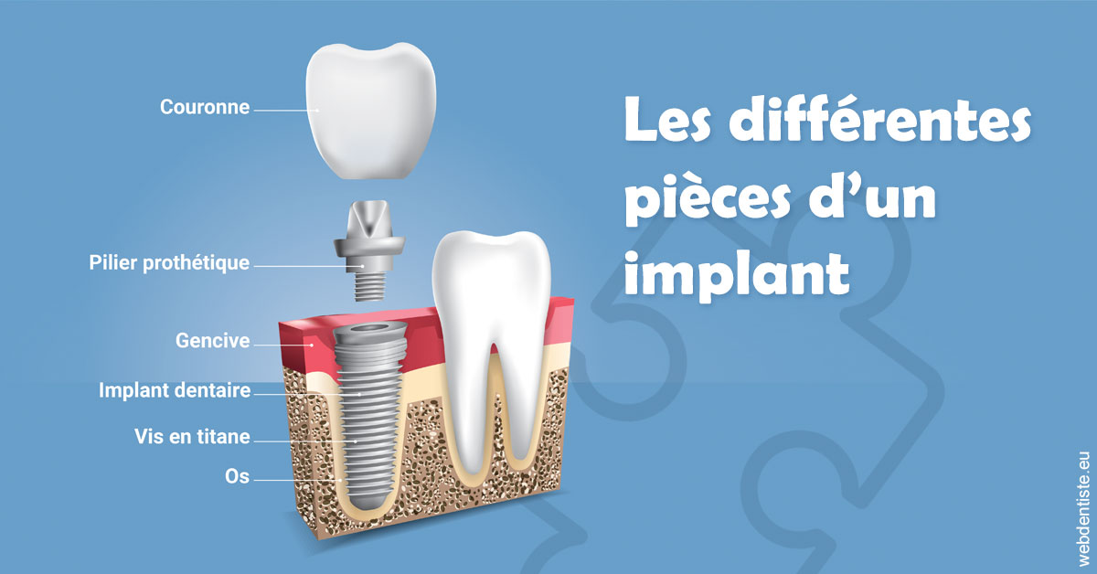 https://www.orthodontie-rosilio.fr/Les différentes pièces d’un implant 1
